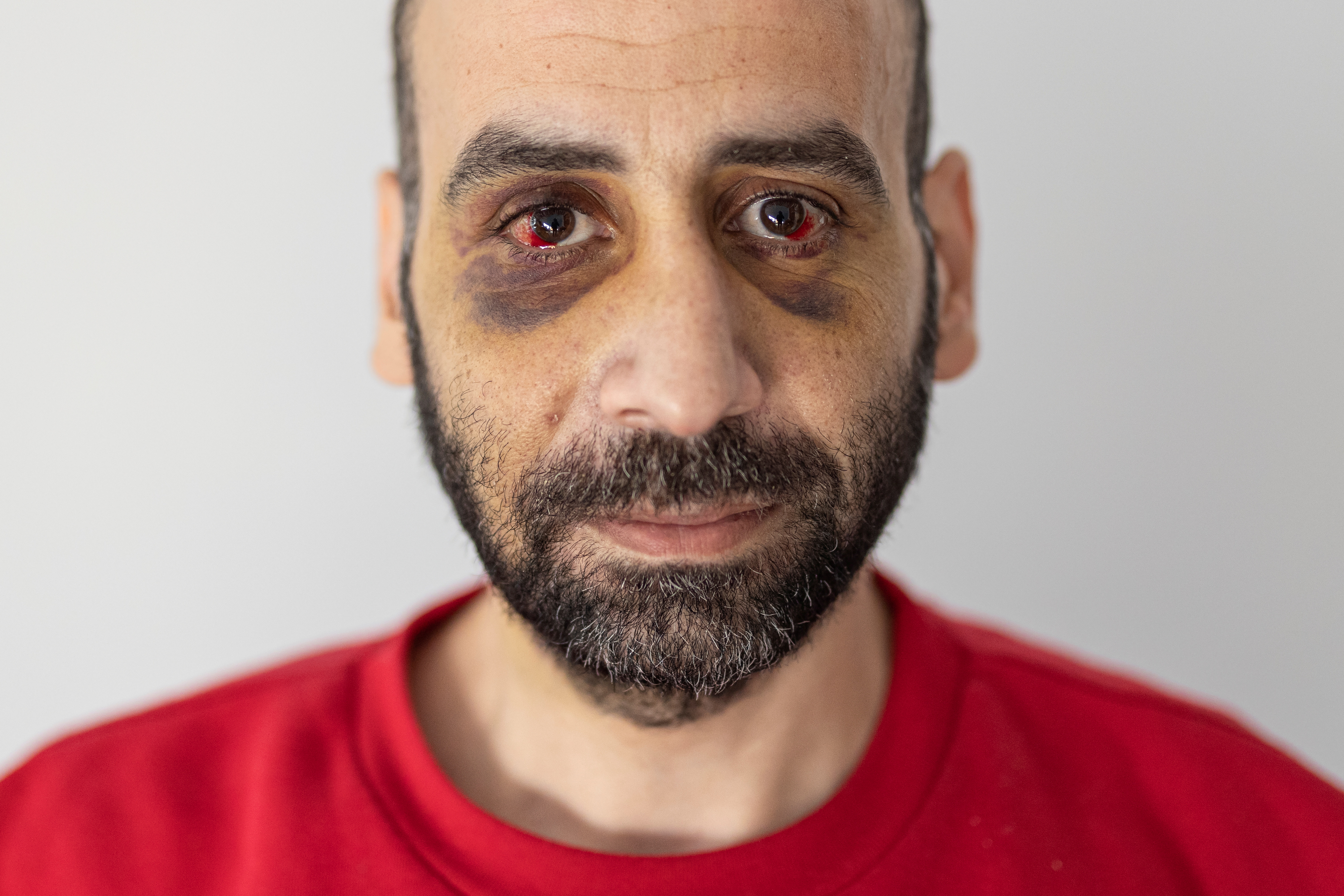 Youssef Atallah, a migrant from Syria, who says he was beaten by the Belarusian border guards, stands in the centre for migrants in Bialystok, Poland, November 10, 2021. REUTERS/Marko Djurica     